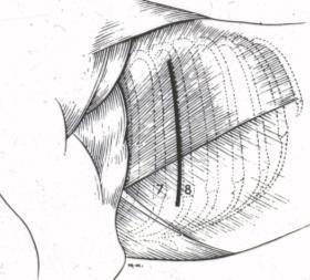 Anestesia - ventilação / medicações 3. Posicionamento decúbito lateral D ou E 4. Antissepsia 5. Colocação dos panos de campo 6. Contar e definir EICs (a partir da 13ª costela) 7.