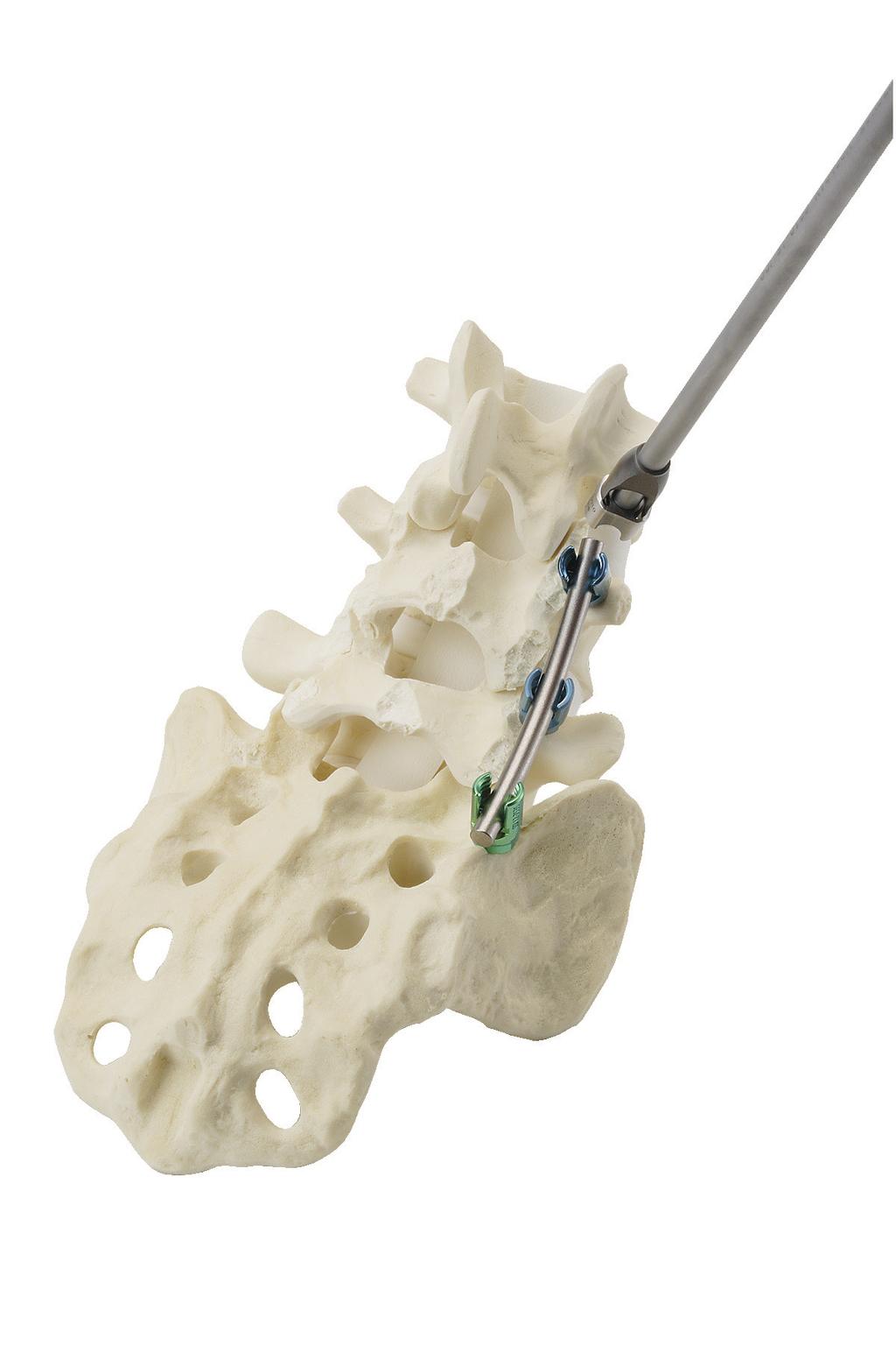 Malibu Pedicle Screw System Surgical Technique PASSO 8 8A 8B Compressão e Distração (opcional) Se for desejada compressão ou distração das vértebras, aperte completamente e bloqueie o parafuso que