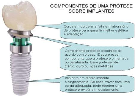 O QUE SÃO IMPLANTES DENTÁRIOS? Os implantes dentários tem como objetivo substituir um dente perdido. São feitos de titânio, material biocompatível com o organismo humano.