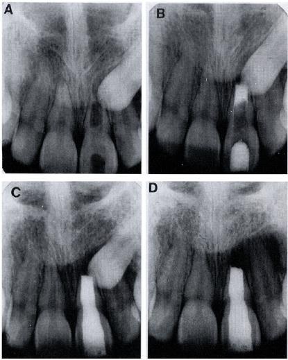 Endodontia de dentes decíduos com MTA Solução em Odontopediatria? Figura 9 Dente 21 com apéx aberto em que se promoveu a apexificação com MTA A Radiografia pré-operatória do 21 com apéx aberto.