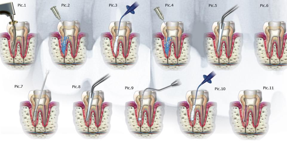 Endodontia de dentes decíduos com MTA Solução em Odontopediatria?