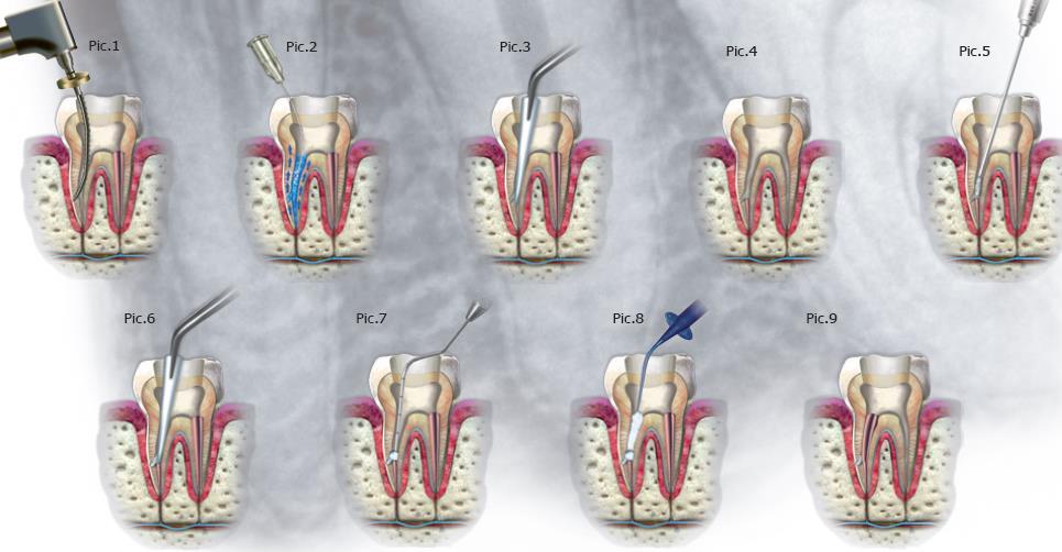 Introdução Um estudo efectuado por Holland et al. (2001) em dentes de cães utilizou hidróxido de cálcio e MTA para a reparação das perfurações radiculares laterais.