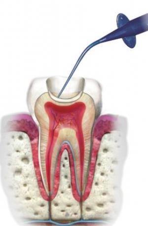Remoção cuidadosa da dentina cariada em profundidade utilizando escavadores de dentina ou contra-ângulo a baixa rotação, com especial cuidado na região mais profunda e
