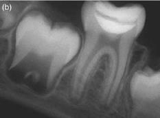 c) Radiografia de controlo após 5,5 anos, em que é visível a completa formação radicular (Srinivasan, Waterhouse & Whitworth, 2009).