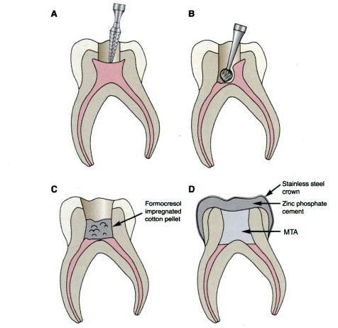 Endodontia de dentes decíduos com MTA Solução em Odontopediatria? 9. Restauração definitiva que proporcione um selamento coronário externo óptimo.