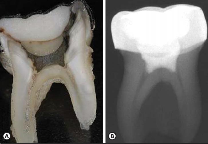 Endodontia de dentes decíduos com MTA Solução em Odontopediatria? Figura 19 Molar decíduo inferior extraído 30 meses após pulpotomia com MTA A Imagem clínica após secção vestíbulo-lingual.