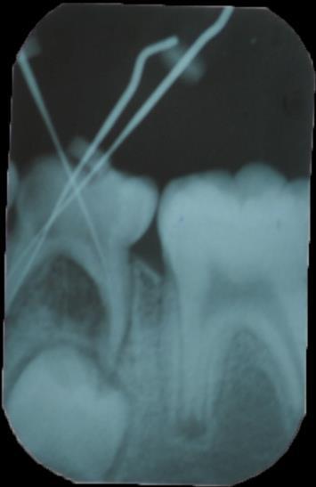 Endodontia de dentes decíduos com MTA Solução em Odontopediatria?