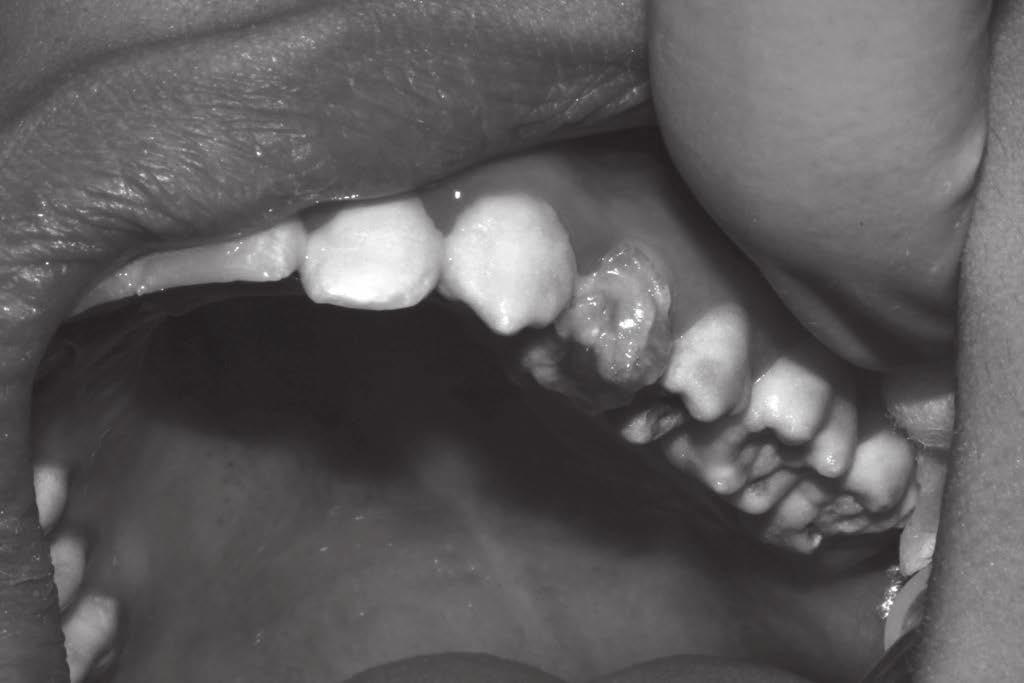 hipersensibilidade dentinária, utilizando agentes dessensibilizantes.