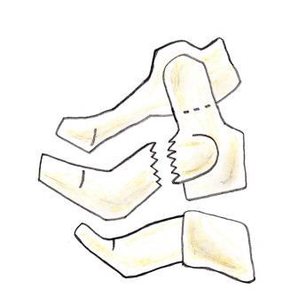 Resulta numa fratura oblíqua da base do processo espinho que sofre avulsão devido à força do ligamento supra-espinhoso. A fratura também Fig.9.