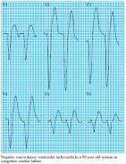 auriculoventricular Concordância QRS ao longo das derivações torácicas Taquicardia ventricular polimórfica Pode degenerar em Fibrilhação ventricular 39 40 RITMOS DE PARAGEM
