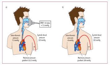 atelectasias e o shunt pulmonar, aumenta a complacência do sistema respiratório e o débito cardíaco dos pacientes com EAP.