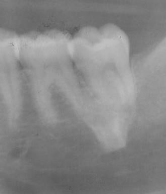 dente 36 e das raízes do dente 37, desde a infância até ao início da terceira década de vida.