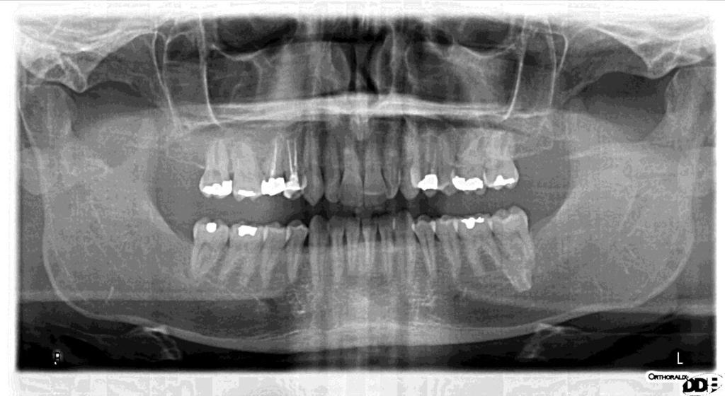 DESCRIÇÃO DO CASO No dia 31 de Outubro de 2011, surgiu na consulta de triagem na Unidade Clínica Cirurgia Oral IV do Curso Mestrado Integrado em Medicina Dentária da Universidade do Porto o paciente