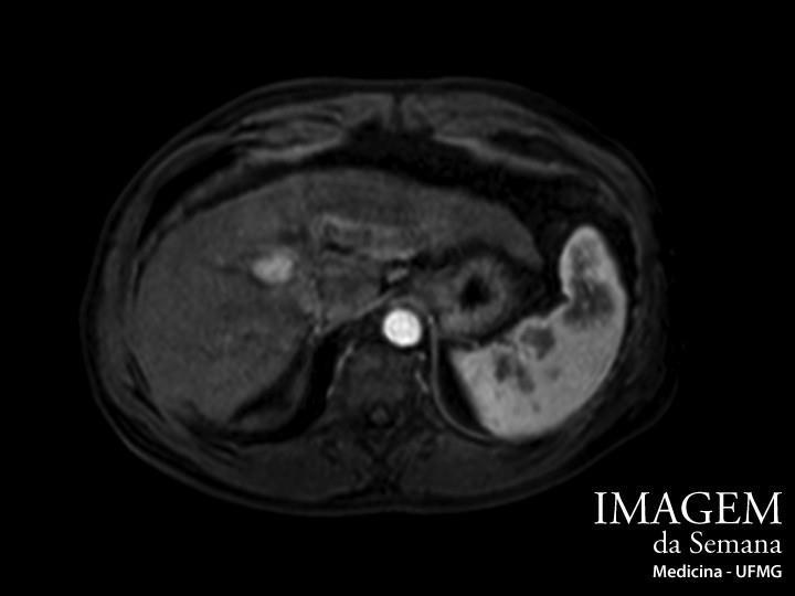 do contraste, em fase arterial. Imagem 02.