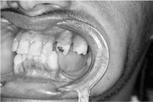 O diagnóstico de Anemia Falciforme geralmente ocorre no primeiro ou segundo ano de vida, detectado precocemente a partir do teste do pezinho (SOARES, et al.; 2013).