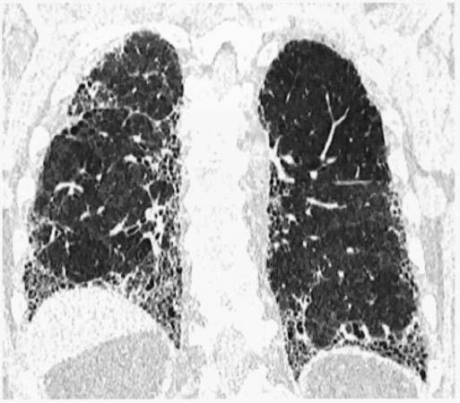 Linfangioliomiomatose é sugerida na TCR devido à presença de numerosos cistos pulmonares de paredes finas distribuídos igualmente por todo o pulmão e rodeados por parênquima pulmonar relativamente