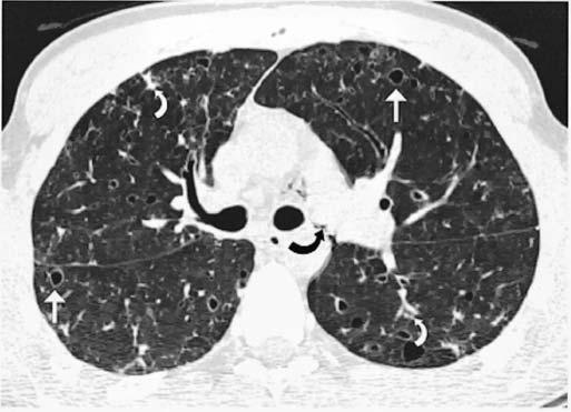 Histiocitose de Langerhans pulmonar em paciente do sexo masculino, 20 anos de idade.