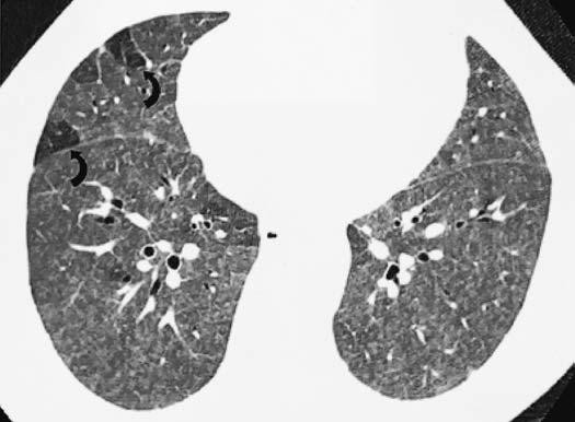 ,: TCR em multidetector (corte axial e reconstrução coronal, respectivamente) evidencia