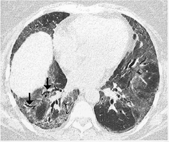 Paciente do sexo feminino, 45 anos de idade, com pneumonia intersticial não-específica.