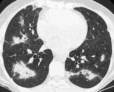 Modelo de interpretação da TCR no diagnóstico diferencial das doenças intersticiais crônicas pneumonia intersticial descamativa é uma entidade rara, quase sempre associada ao tabagismo, e de bom