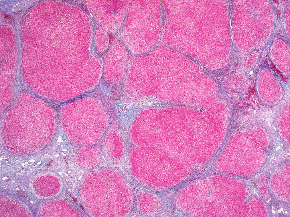 ducto ) (seta) envolvido por reação granulomatosa epitelioide e infiltrado