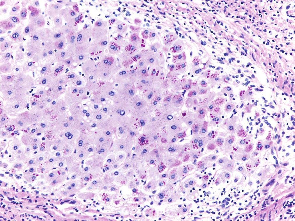 extensa área de necrose centrolobular em maior aumento ((H&E, 20x). Figura e38.