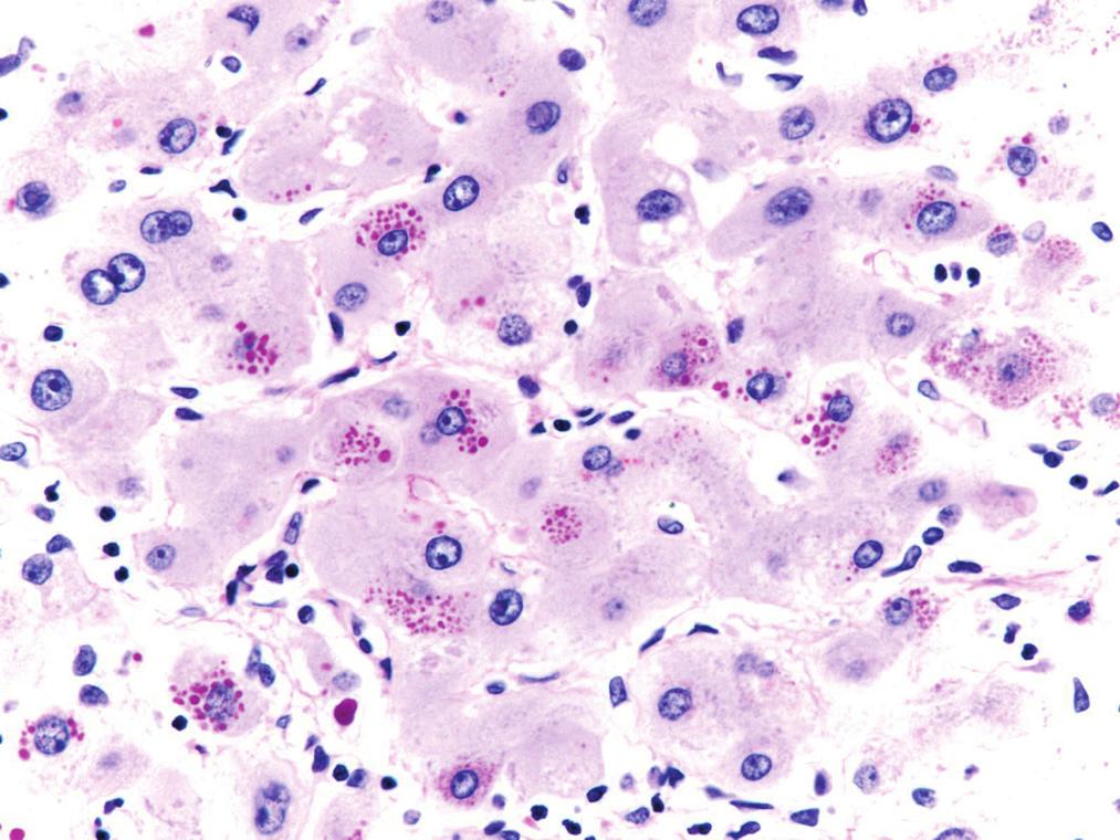 hemossiderina (ferro) presente no fígado cirrótico, enquanto que os nódulos do carcinoma