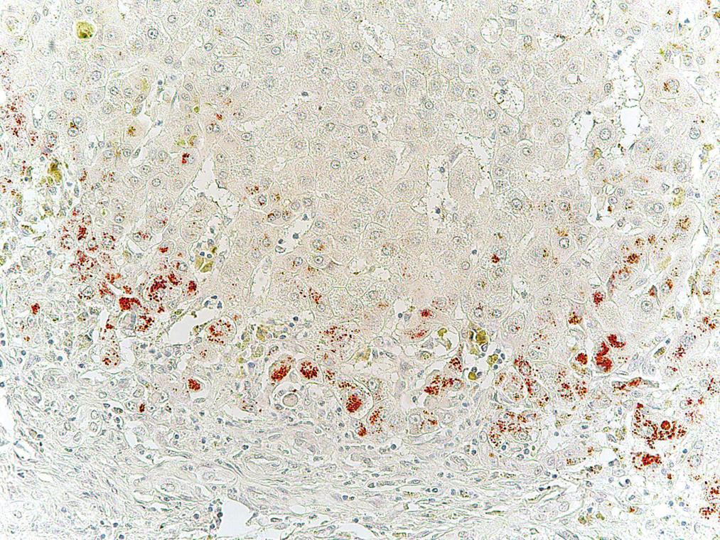 fígado explantado obtido no momento da hepatectomia para transplante hepático