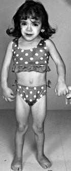 RESIDÊNCIA MÉDICA SUPLEMENTAR 05 ) Menina de quatro anos (imagem a seguir) é levada à consulta em um ambulatório devido à baixa estatura.