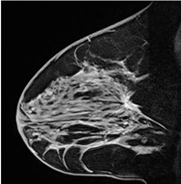 Lesão radial complexa Arranjo de estruturas ductais proliferativas com fundo esclerótico e núcleo fibroelastótico