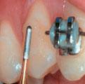 This study intends to evaluate, according to literature, the different techniques used to remove metallic and ceramic brackets and the adhesive material remainder; and also to