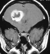 4 Caso 5 RM, plano coronal, poneração T1 após injecção de gadolíneo: meduloblastoma desmoplásico, manifestado por ataxia da marcha, localizado no hemisférico cerebeloso com extensão superficial, com