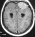 2 Caso 2 Esquerda - RM plano axial, ponderação T1 após injecção de gadolíneo: lesão agressiva do hemisfério cerebeloso, com área necrótica central e com realce de sinal intenso periférico e irregular.