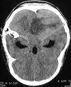 quimioterapia (direita). Fig..3 Caso 3 Esquerda TC sem contraste: lesão do hemisfério cerebeloso, espontaneamente hiperdensa, com extensão superficial.
