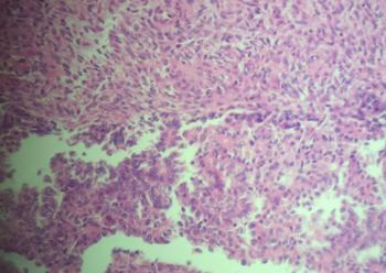 Fig.3 Curetagem uterina - Carcinossarcoma (Coloração de Hematoxilina e Eosina, 200x) componente sarcomatosa do carcinossarcoma e de as células epiteliais terem características citológicas glandulares