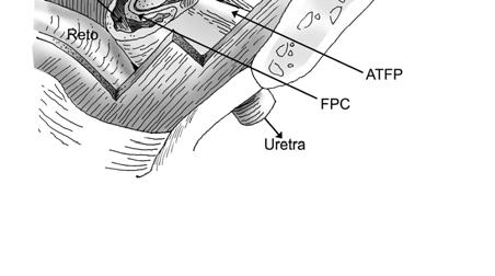 Quando este mecanismo falha, a JUV torna-se hipermóvel e a uretra permanece aberta quando a pressão intra-abdominal aumenta, provocando IUE.