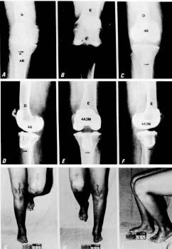 L.A. MESTRINER & J. LAREDO F Fig. 2 Prótese idealmente implantada em artrite reumatóide Fig. 3 Prótese idealmente implantada em osteoartrose Special Surgery a partir de 1978.