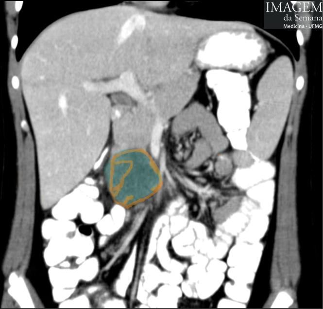 em seu maior diâmetro. Textura predominantemente cística, com realce leve pelo meio de contraste iodado endovenoso em parede e sem septações internas.