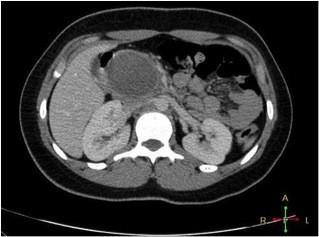 Imagem 4: Cortes de TC de abdome após administração de contraste iodado venoso e oral, evidenciando cistadenoma seroso (seta azul), disponível em: http://www.radiologyassistant.