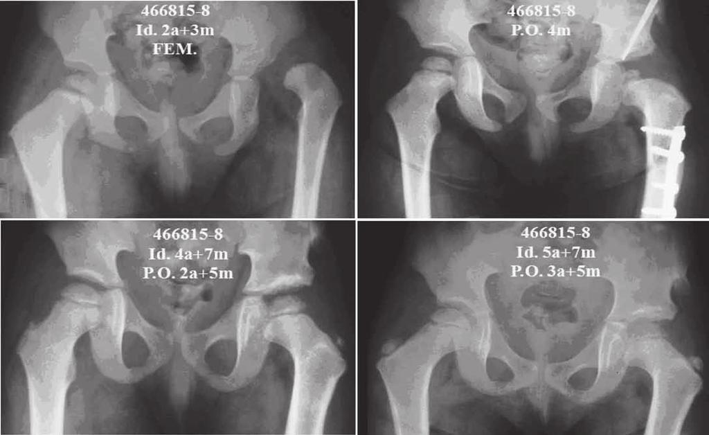 uma osteonecrose e uma osteonecrose associada a subluxação, sendo o caso da subluxação isolada tratado com outro procedimento cirúrgico.