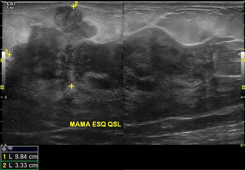 Fig. 1a Figura 1: Caso 1 - Exame de US de paciente de 29 anos, 3 meses pósparto, amamentando, com queixa de aumento