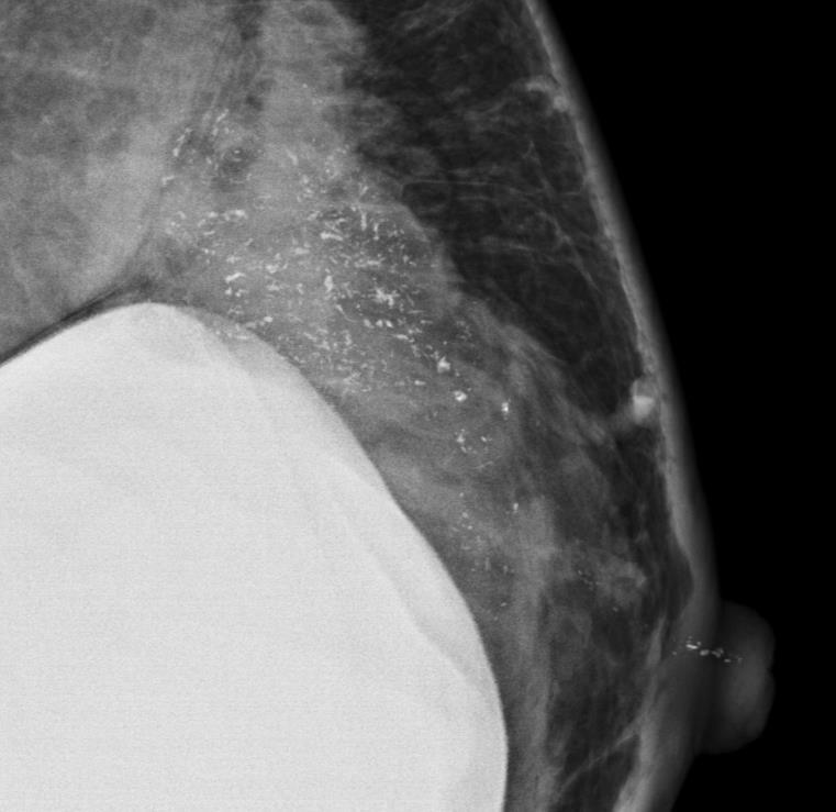 AP: carcinoma mamario infiltrante pouco