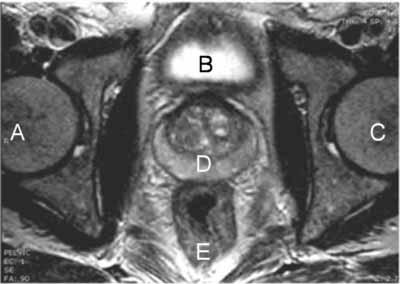 MRI da próstata A - Cabeça do fêmur direito B - Bexiga C - Cabeça do