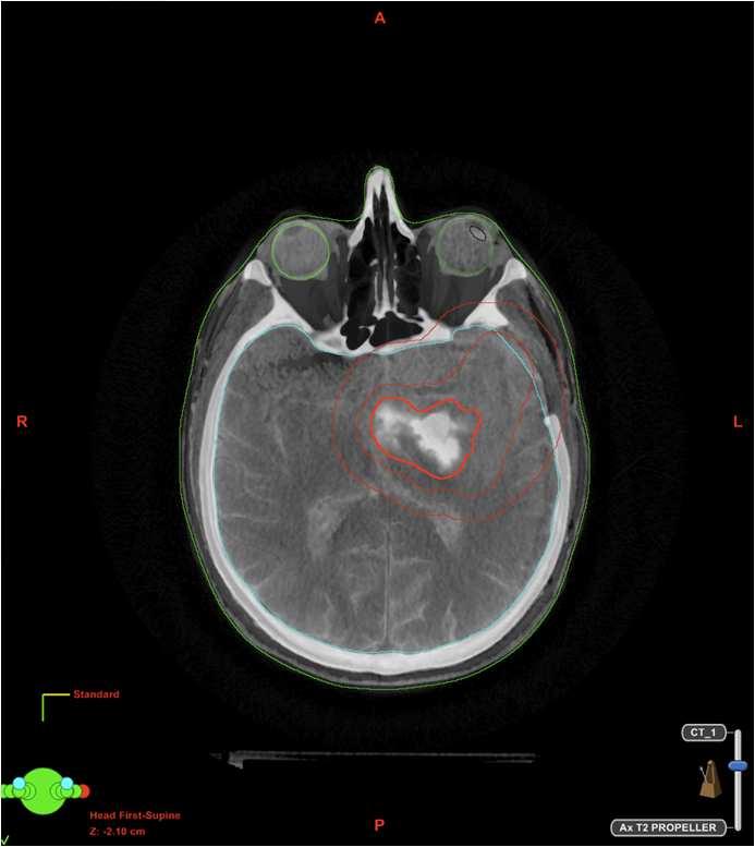 Técnica de Radioterapia Esses tumores são geralmente não contrastados e são melhores visualizados com RNM FLAIR e/ou T2 GTV= áreas anormais na RNM