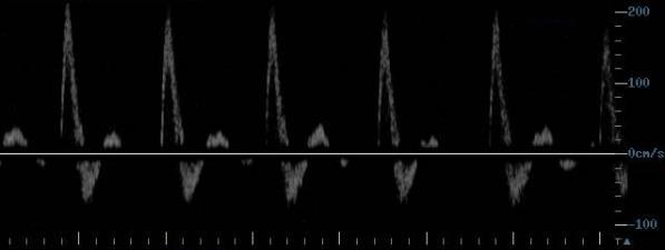 118 AOB AIE AFE Figura 1 Exemplos de imagens espectrais obtidas através de ultrassonografia Doppler das artérias celíaca (AC), mesentérica