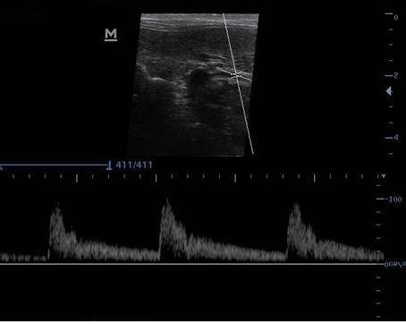 47 Figura 12 Morfologia da onda Doppler espectral da artéria celíaca. Fonte: próprio autor. 3.4.2.2.2 Artéria mesentérica cranial Situa-se ligeiramente cranial à origem da artéria renal direita e caudal à origem da artéria celíaca.