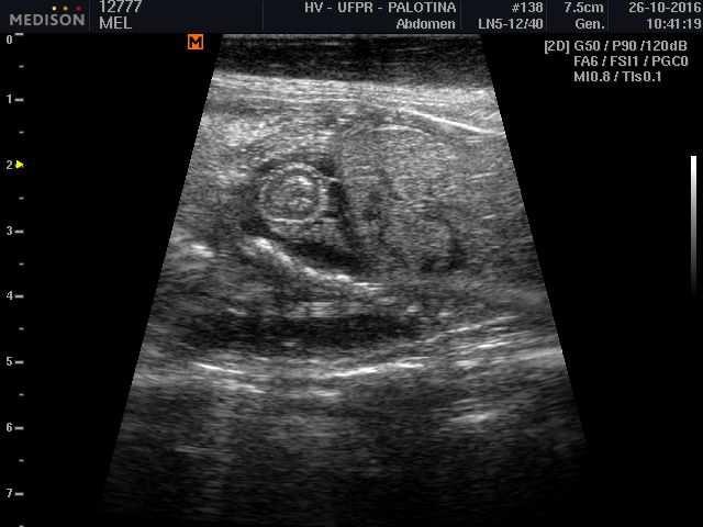 Imagem V e VI Imagem ultrassonográfica demonstrando feto com cavidade torácica preenchida por conteúdo anecogênico.
