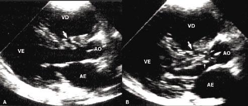 Nestes casos, a ecocardiografia tem um papel importante no diagnóstico e na análise da repercussão hemodinâmica 6, já que, quando realizada em recém-nascidos não selecionados, incluindo aqueles sem