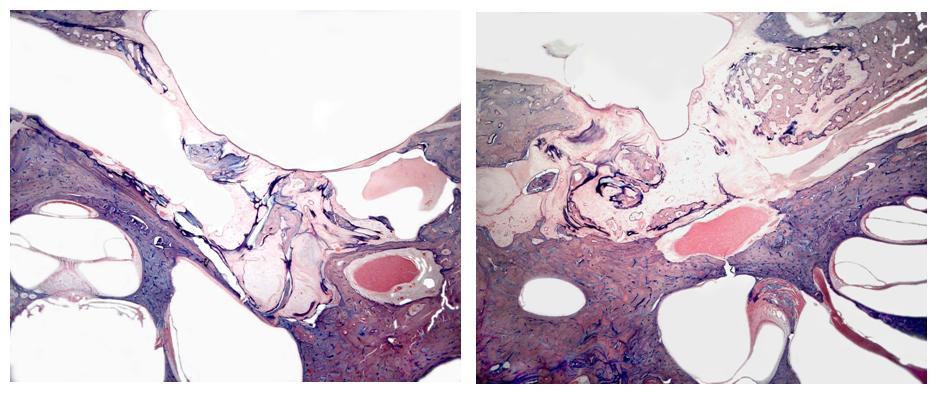 Figura 2 Em A, corte histológico da orelha direita com retração da MT, erosão óssea, tecido de granulação e timpanoesclerose na orelha média.