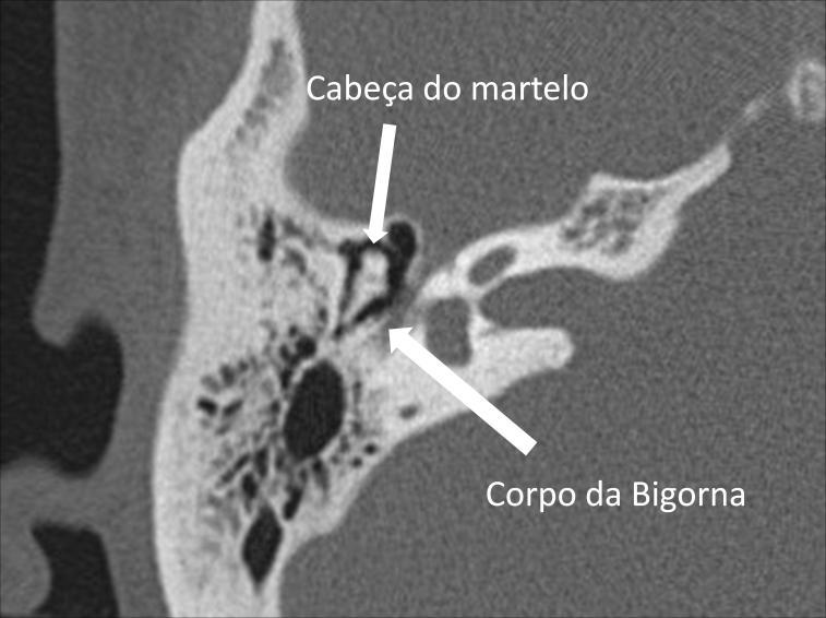 Figura 9 - Plano axial orelha direita: visualização de articulação incudo-maleolar no epitímpano.